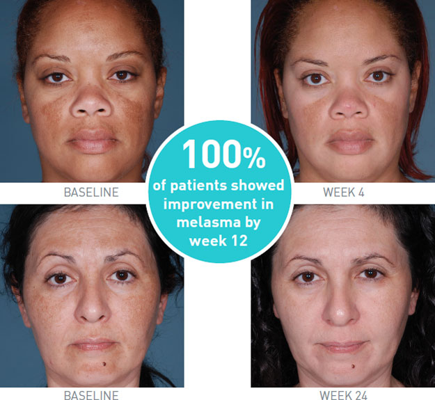 Obagi Skin Treatment in Hendersen, KY